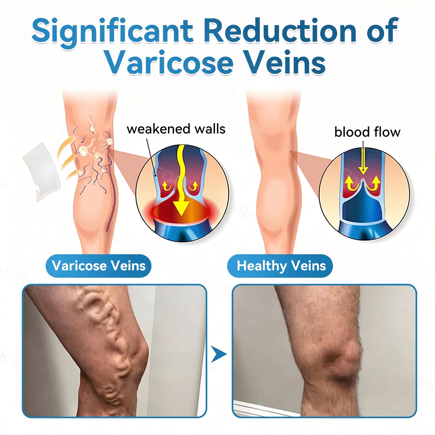 🏆✅️🎈𝐕𝐞𝐢𝐧𝐑𝐞𝐩𝐚𝐢𝐫 𝐌𝐢𝐜𝐫𝐨𝐧𝐞𝐞𝐝𝐥𝐞 𝐏𝐚𝐭𝐜𝐡 𝐑𝐨𝐥𝐥⚡Instant Relief, Long-Term Results