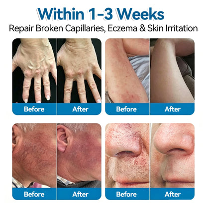 🏆✅️🎈𝐕𝐞𝐢𝐧𝐑𝐞𝐩𝐚𝐢𝐫 𝐌𝐢𝐜𝐫𝐨𝐧𝐞𝐞𝐝𝐥𝐞 𝐏𝐚𝐭𝐜𝐡 𝐑𝐨𝐥𝐥⚡Instant Relief, Long-Term Results
